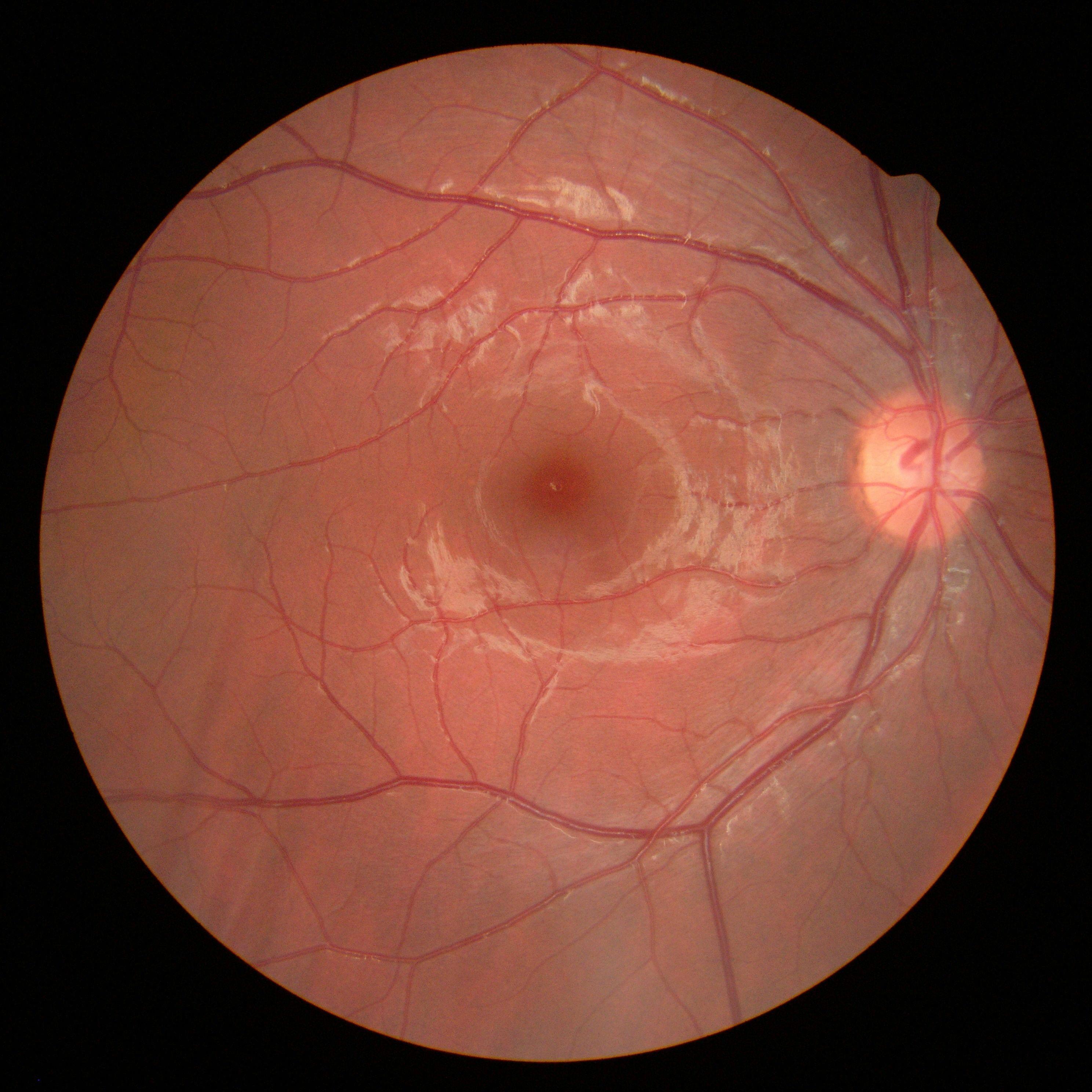 Gene Therapy for Diabetic Macular Edema Halted Following Serious Adverse Reaction 