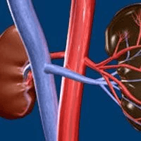 renal cell carcinoma